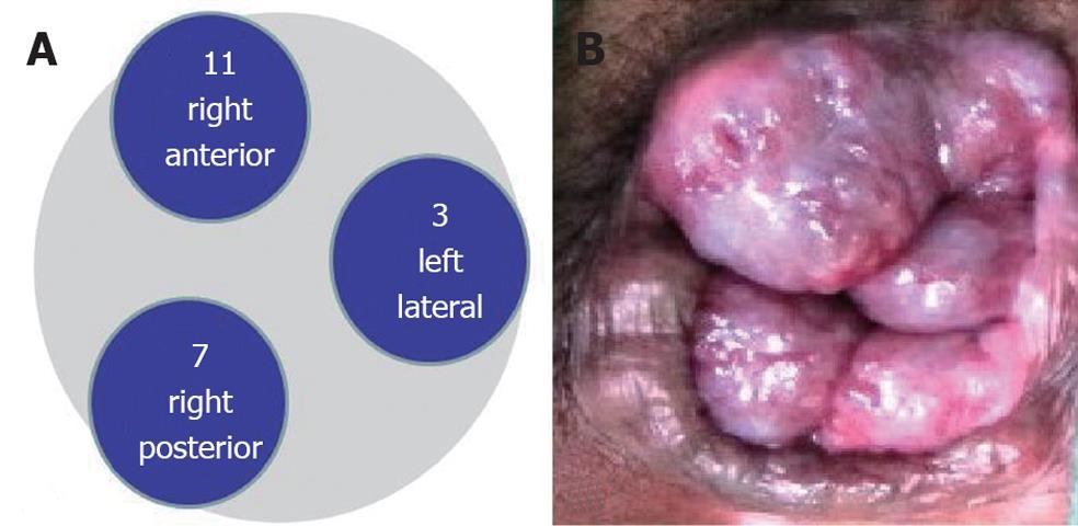  piles hemorrhoids 2